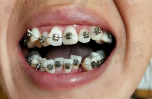 做假牙和补牙有什么区别,接牙和补牙的区别(图1)